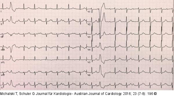 EKG