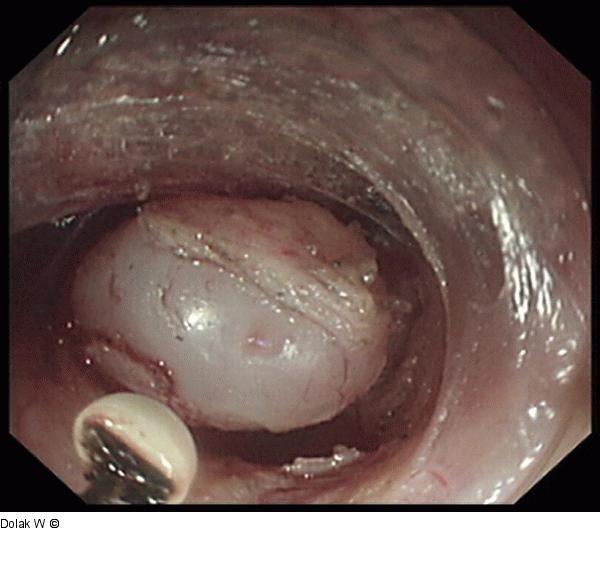 Subepithelialer Tumor