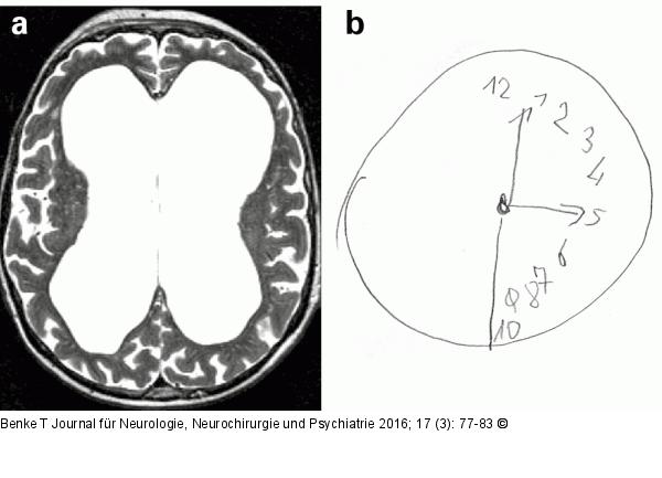 Dysexekutives Syndrom