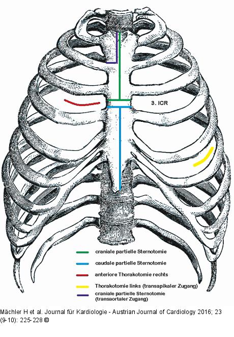 Aortenklappenchirurgie - OP-Techniken