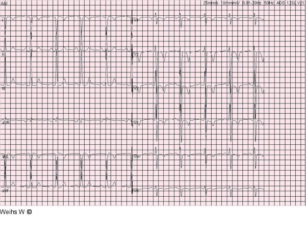 EKG