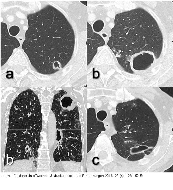 Nocardia abscessus
