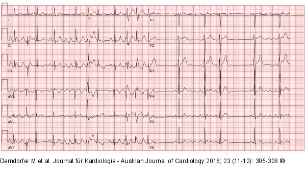 EKG