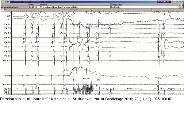 EKG