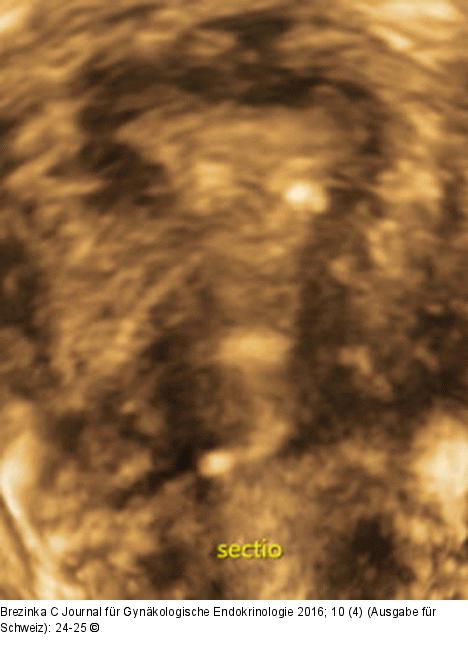 Subendometriale Fibrose