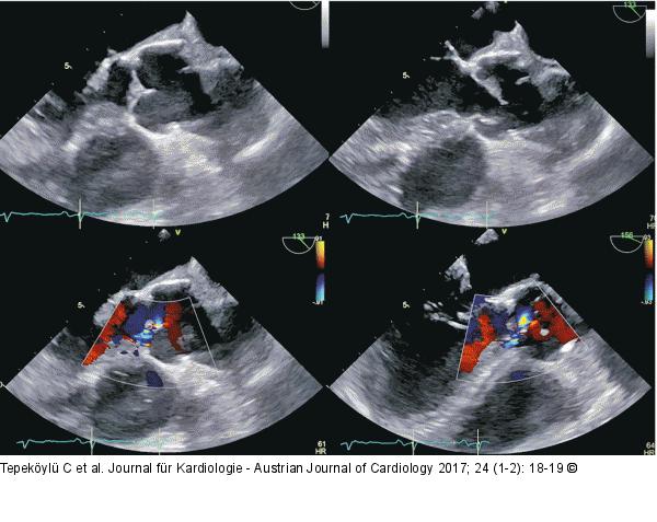 Transsophageales Echo