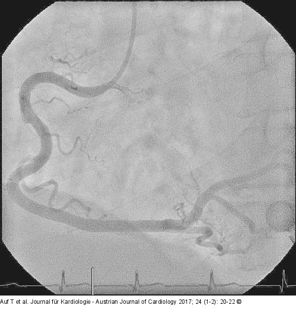 Angiographie
