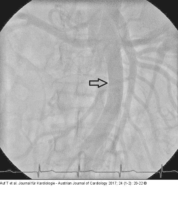 Angiographie