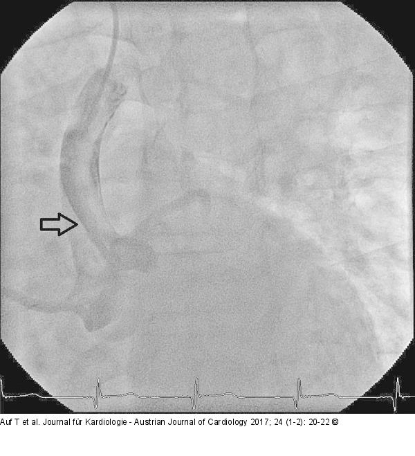 Angiographie
