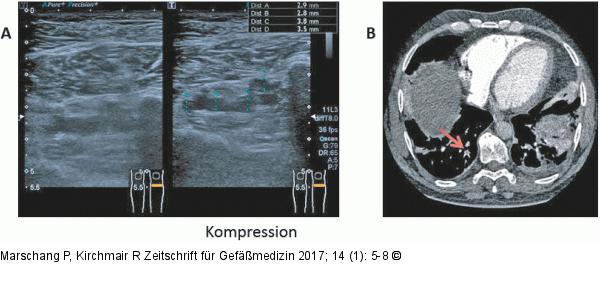Distale Thrombose