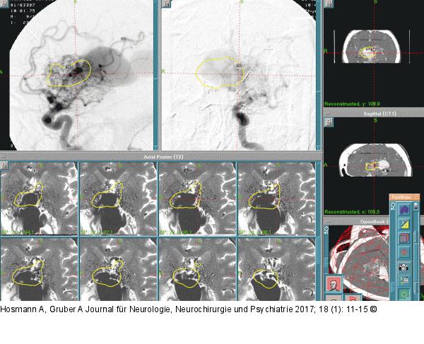Gamma-Knife-Behandlung