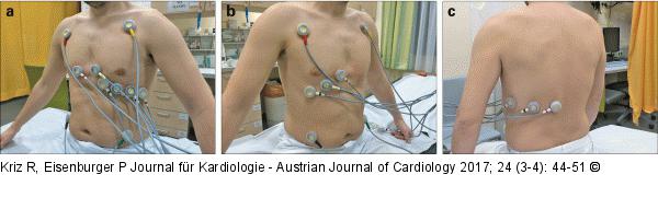 EKG