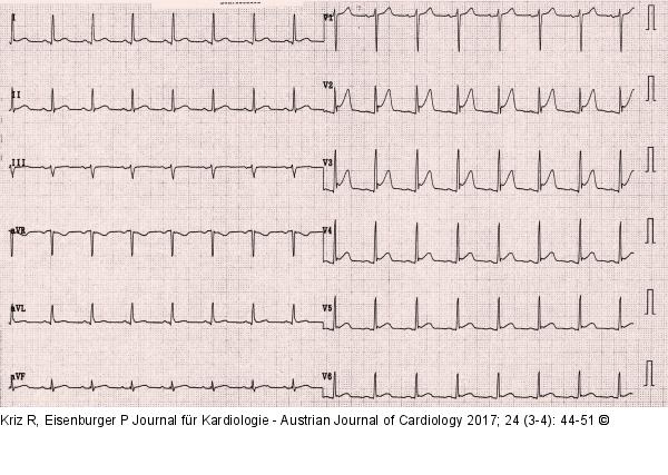 EKG
