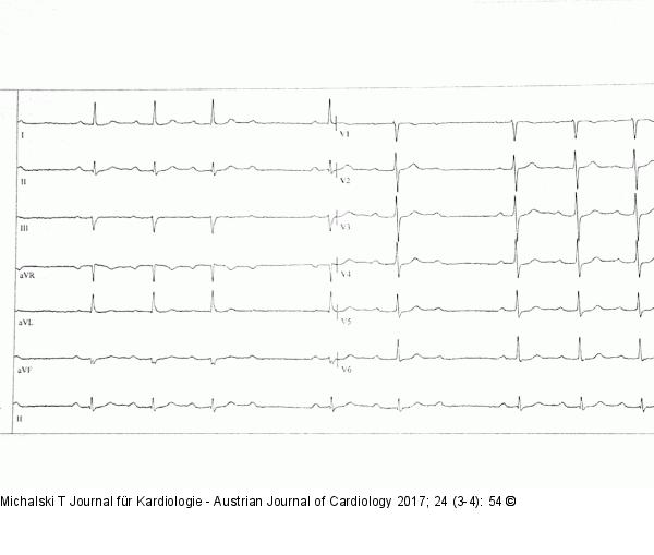 EKG