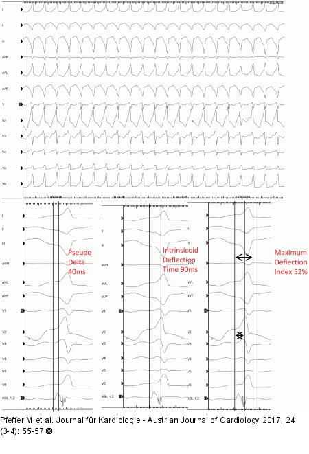 EKG