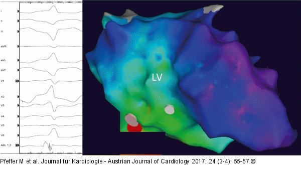 Farbkodiertes Aktivierungsmap