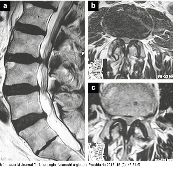 Vertebrostenose