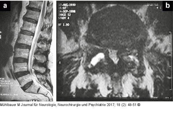 Vertebrostenose