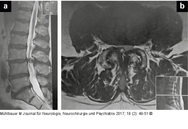 Vertebrostenose