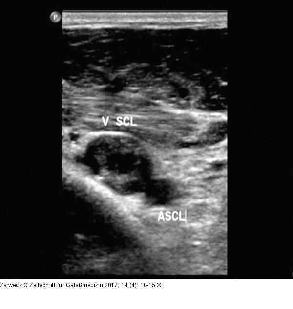 Thrombus - Vena subclavia