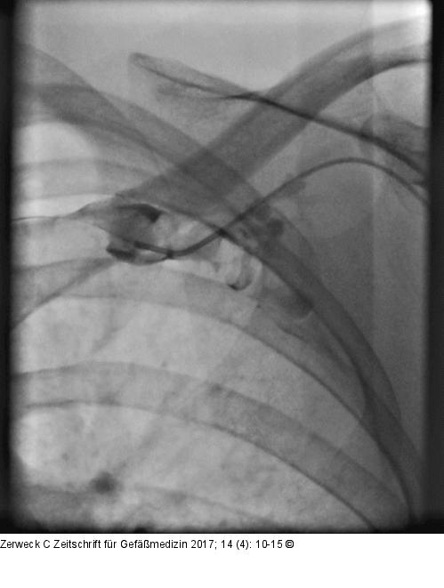 Printerventionelle Angiographie