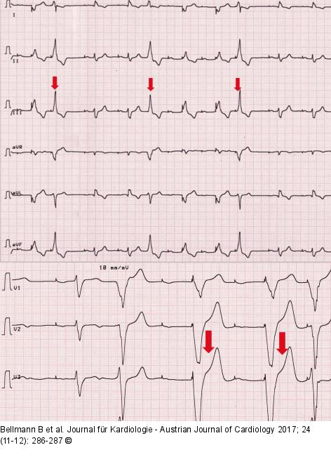 Ventricular premature beats