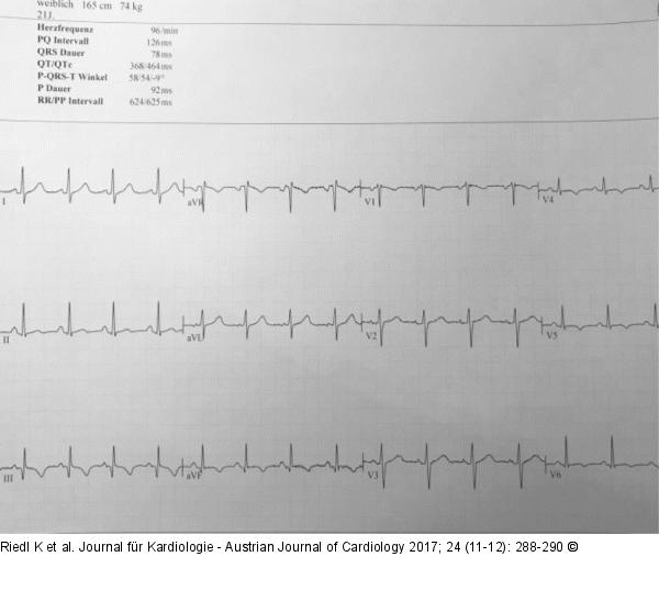 EKG