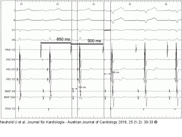 EKG