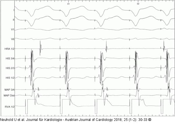 EKG