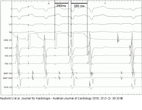 EKG 