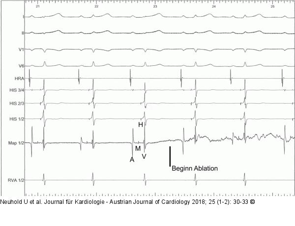 EKG