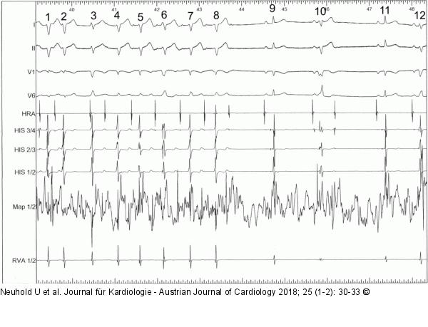 EKG