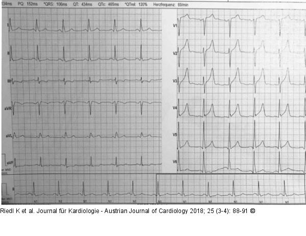EKG