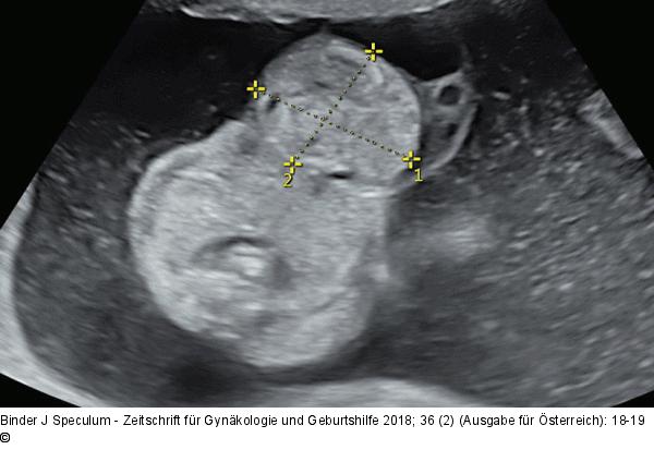 Omphalocele