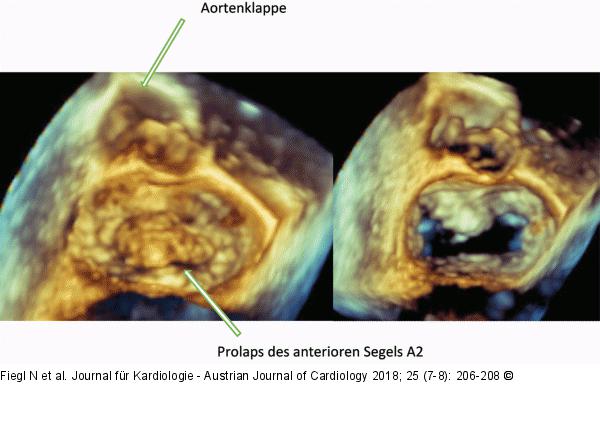 3D-TEE surgical view