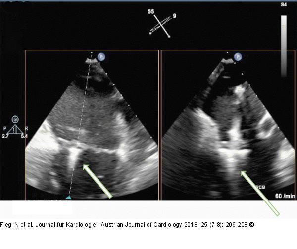 MitraClip-Implantation
