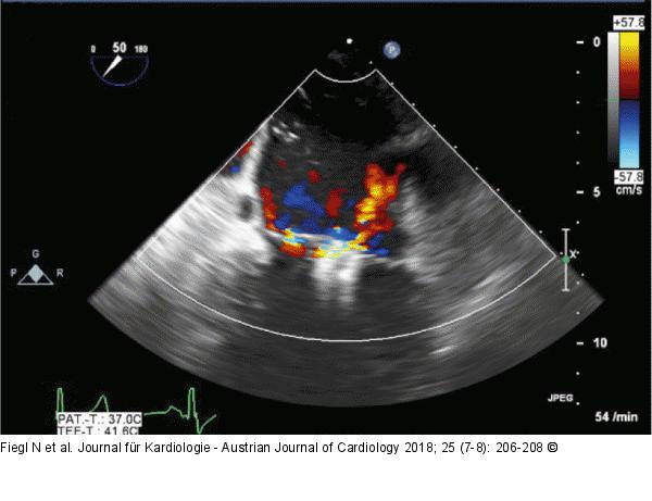 MitraClip-Implantation
