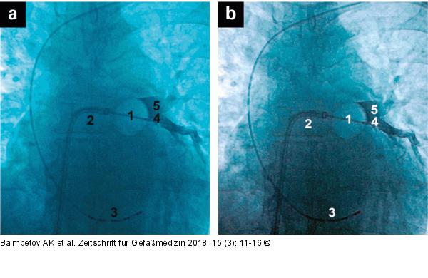 Cryoablation of LUPV