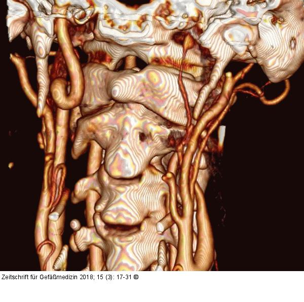 CTA with 3D reconstruction