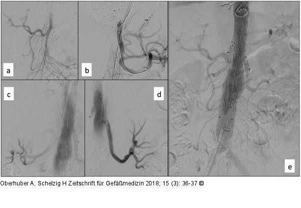 Produkt: Stentgraft<br>
Vertrieb: Jotec GmbH