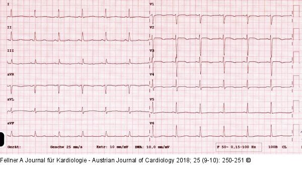 EKG