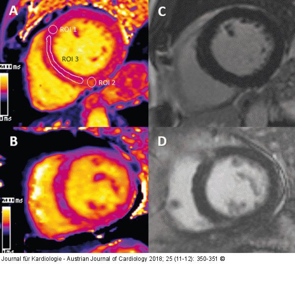 HFpEF
