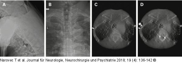Perkutane Insertion