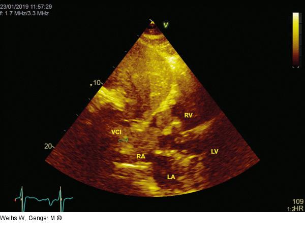 Vena cava inferior