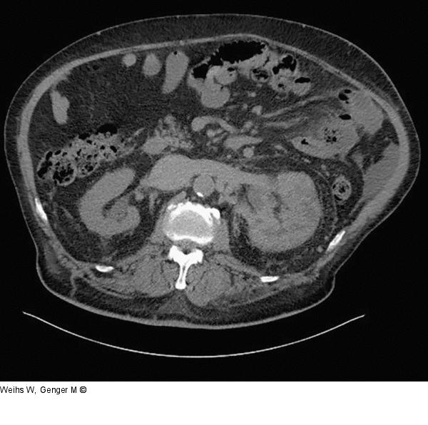 CT-Abdomen