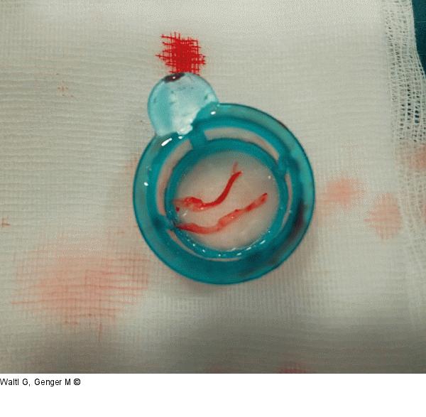 Thrombus