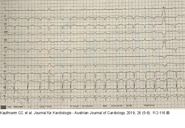 Amyloidose-EKG