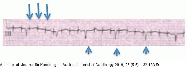 EKG