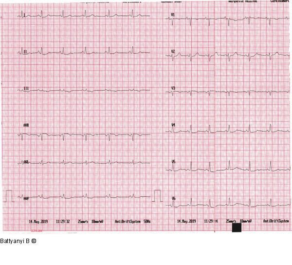 EKG