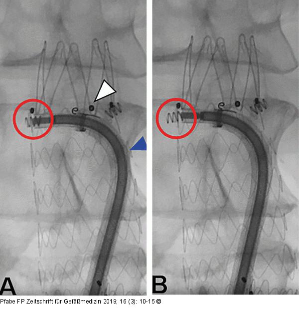 EndoAnchor